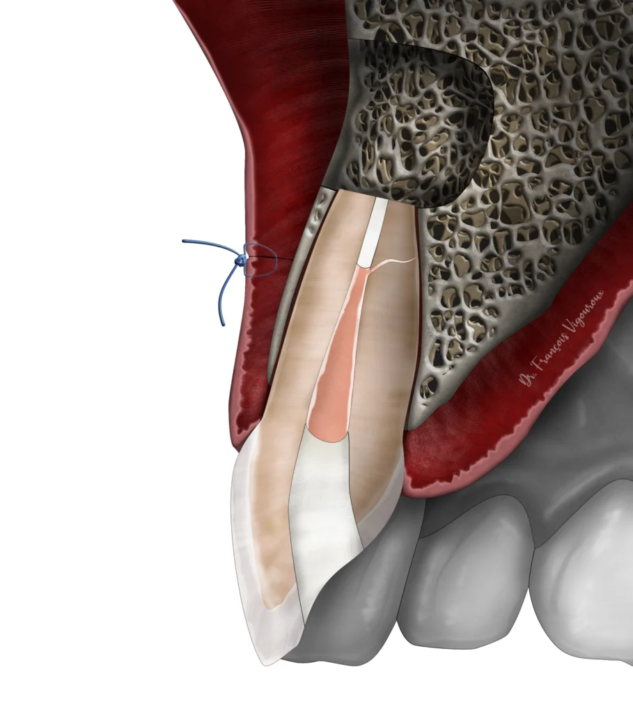 La micro-chirurgie endodontique au Cabinet EndoSpé, endodontie exclusive à Paris 15ᵉ